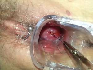Mirena Spiraleのziehen除去IUD IUP entfernen